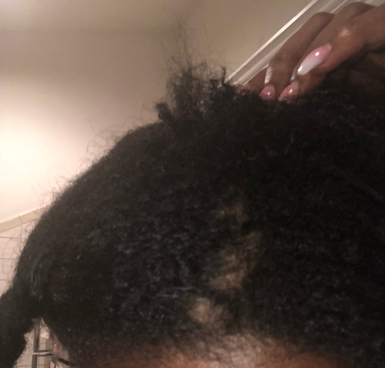 5 Triggers for Traction Alopecia